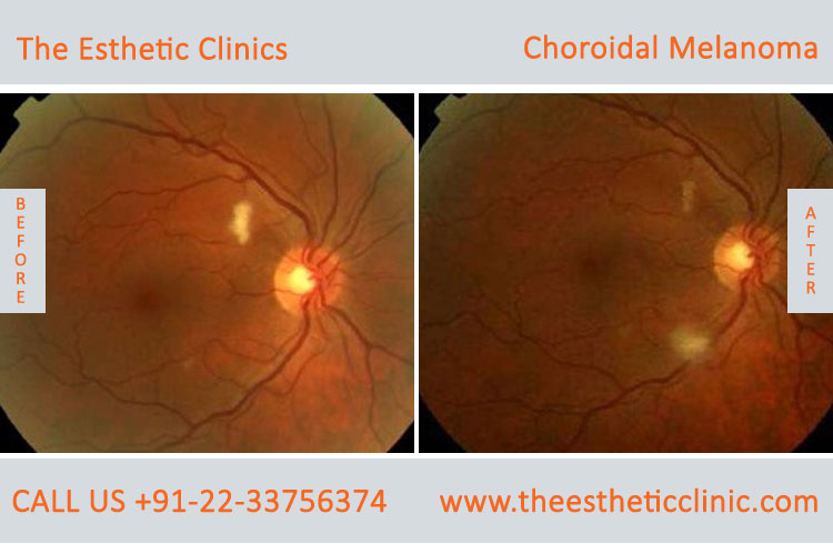 Choroidal Melanoma Eye Cancer Treatment before after photos in mumbai india (1)